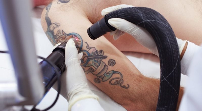 Ephemeral Tattooentfernung ohne Laser