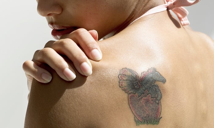 Tattoo entfernen ohne Laser