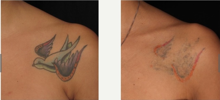 Tattoo entfernen Laser Entfernung