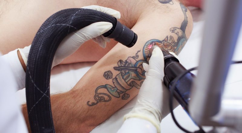 Tattoo entfernen mit Laser