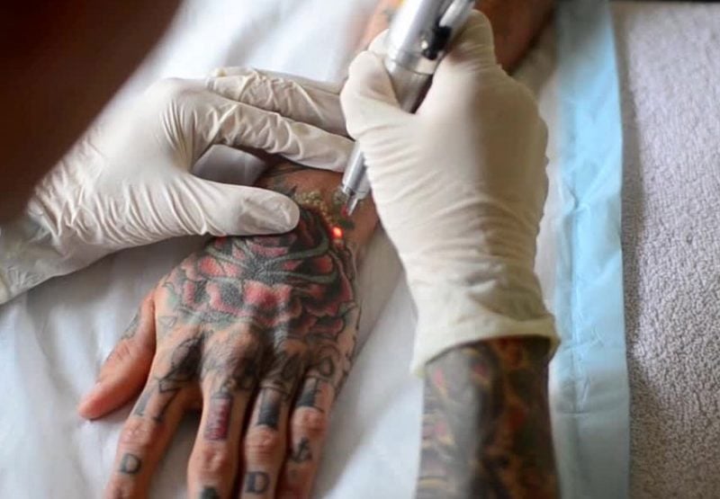 Tattoo entfernen Erfahrung