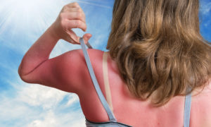 Sonnenbrand behandeln hilfreiche Tipps