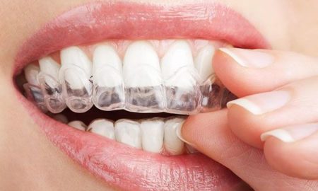 Zahnschiene Tipps: Alles, was Sie für Aligner wissen müssen
