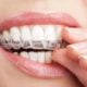 Zahnschiene Tipps: Alles, was Sie für Aligner wissen müssen